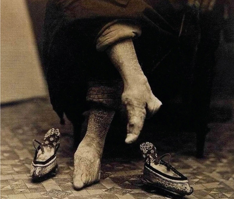 Перевязка ступней